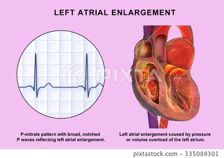 Left atrial dilation with P-mitrale, 3D illustration Left atrial dilation with P-mitrale, 3D illustration 135089301