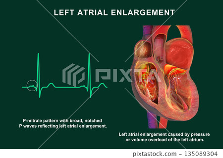 Left atrial dilation with P-mitrale, 3D illustration Left atrial dilation with P-mitrale, 3D illustration 135089304