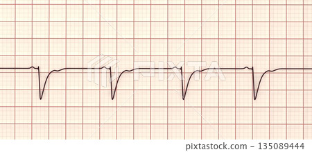 Left ventricular hypertrophy, 3D illustration Left ventricular hypertrophy, 3D illustration 135089444