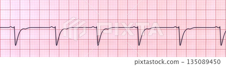 Left ventricular hypertrophy, 3D illustration 135089450