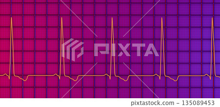Left ventricular hypertrophy, 3D illustration 135089453