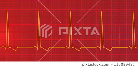 Left ventricular hypertrophy, 3D illustration 135089455