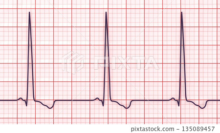 Left ventricular hypertrophy, 3D illustration 135089457