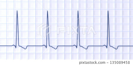 Left ventricular hypertrophy, 3D illustration 135089458