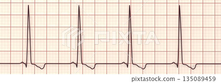 Left ventricular hypertrophy, 3D illustration 135089459