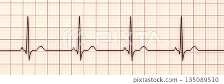 P-pulmonale, 3D illustration P-pulmonale, 3D illustration 135089510