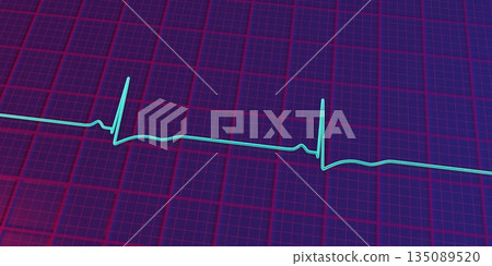 Right ventricular hypertrophy, 3D illustration Right ventricular hypertrophy, 3D illustration 135089520