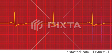 Right ventricular hypertrophy, 3D illustration 135089521