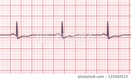 Right ventricular hypertrophy, 3D illustration Right ventricular hypertrophy, 3D illustration 135089523