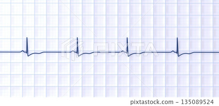 Right ventricular hypertrophy, 3D illustration Right ventricular hypertrophy, 3D illustration 135089524