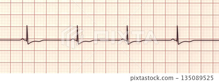 Right ventricular hypertrophy, 3D illustration 135089525