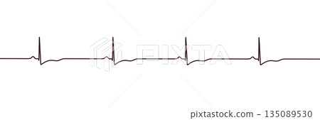 Right ventricular hypertrophy, 3D illustration Right ventricular hypertrophy, 3D illustration 135089530