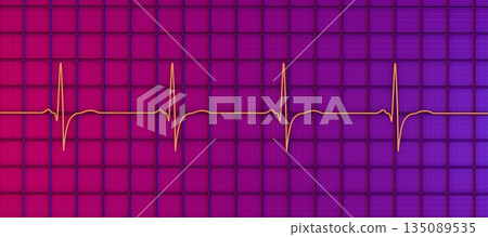 Right ventricular hypertrophy, 3D illustration Right ventricular hypertrophy, 3D illustration 135089535