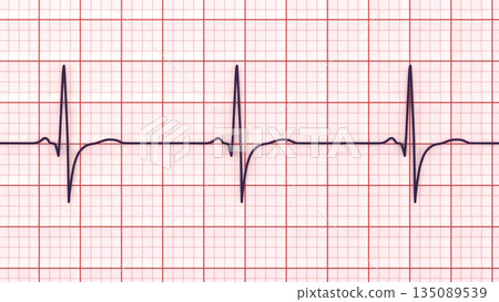 Right ventricular hypertrophy, 3D illustration Right ventricular hypertrophy, 3D illustration 135089539