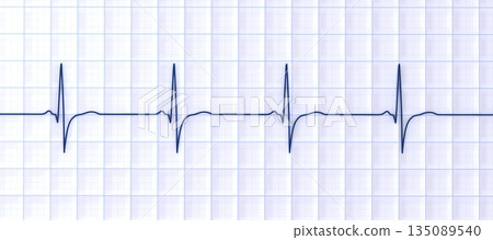 Right ventricular hypertrophy, 3D illustration 135089540