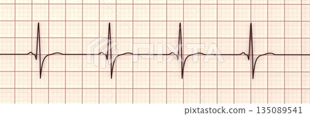 Right ventricular hypertrophy, 3D illustration 135089541