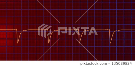 Left ventricular hypertrophy, 3D illustration 135089824