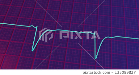 Left ventricular hypertrophy, 3D illustration Left ventricular hypertrophy, 3D illustration 135089827