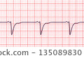 Left ventricular hypertrophy, 3D illustration 135089830