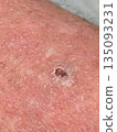 atopic dermatitis 135093231