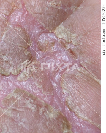 Severe palm injury 135093233