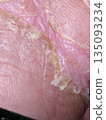 Dry skin 135093234