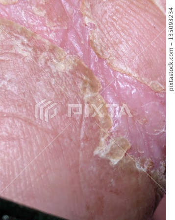 Dry skin Dry skin 135093234