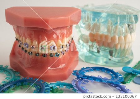 Orthodontic ligatures rings and ties, elastic rubber bands on orthodontic braces, model for dentist studying about dentistry. Orthodontic ligatures rings and ties, elastic rubber bands on orthodontic braces, model for dentist studying about dentistry. 135100367
