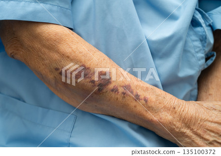 Ecchymosis, elderly bleeding on her arm after taking aspirin. 135100372