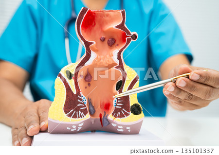 Asian doctor with rectum and hemorrhoid human anatomy model at hospital, inflamed vascular structure. Asian doctor with rectum and hemorrhoid human anatomy model at hospital, inflamed vascular structure. 135101337
