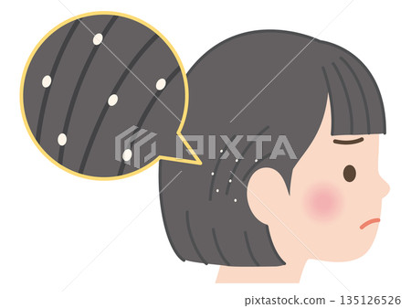 一個孩子的頭髮裡有蝨卵 一個孩子的頭髮裡有蝨卵 135126526