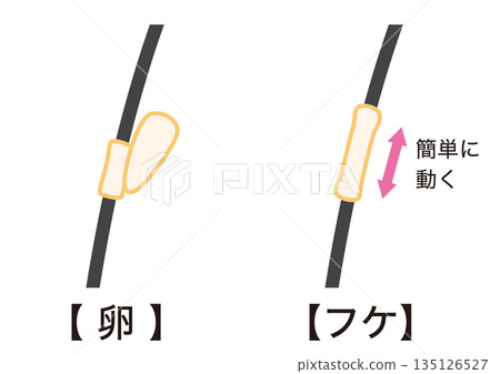 How to distinguish between head lice eggs and dandruff 135126527