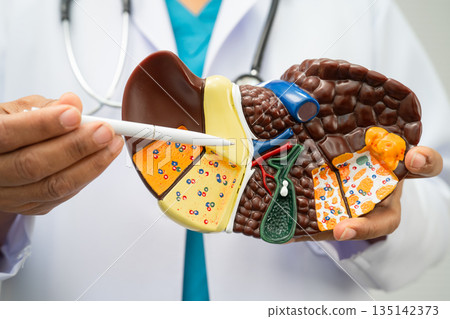 Cirrhosis, Liver cancer, fatty liver, Asian woman with liver human anatomy model. 135142373