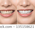 牙齒發黃程度與美白前後的對比 135158621