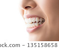 一位女士戴著矯正器，露出潔白美麗的牙齒，笑容燦爛。 135158658