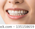 一位女士戴著矯正器，露出潔白美麗的牙齒，笑容燦爛。 135158659