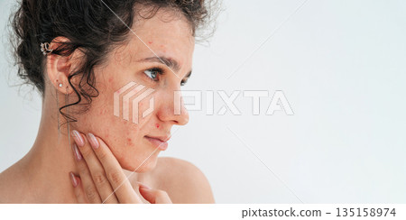 portrait of a sad teenage girl with pimples and acne on problematic facial skin. Face of adult woman with bad red inflamed skin and acne in close up on white isolated background 135158974
