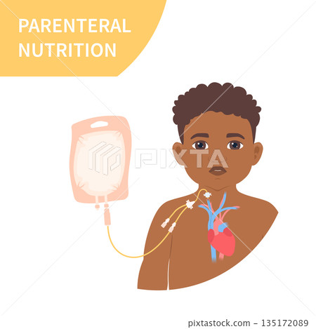 Child receiving parenteral nutrition through a central intravenous access 135172089