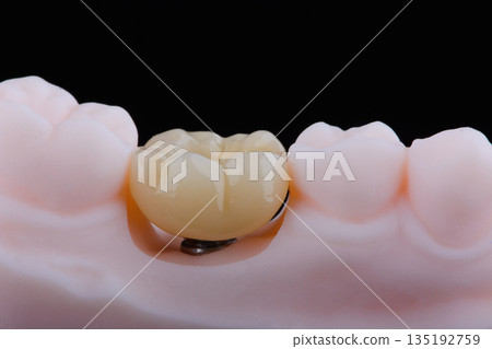Two dental crown of molar made of zirconium on titanium abutments for fixation to implant Two dental crown of molar made of zirconium on titanium abutments for fixation to implant 135192759