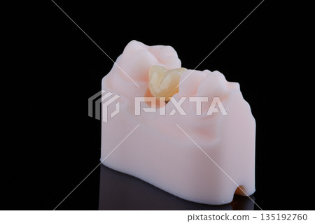 Two dental crown of molar made of zirconium on titanium abutments for fixation to implant Two dental crown of molar made of zirconium on titanium abutments for fixation to implant 135192760