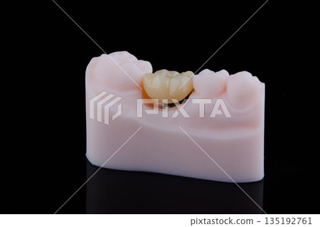 Two dental crown of molar made of zirconium on titanium abutments for fixation to implant Two dental crown of molar made of zirconium on titanium abutments for fixation to implant 135192761