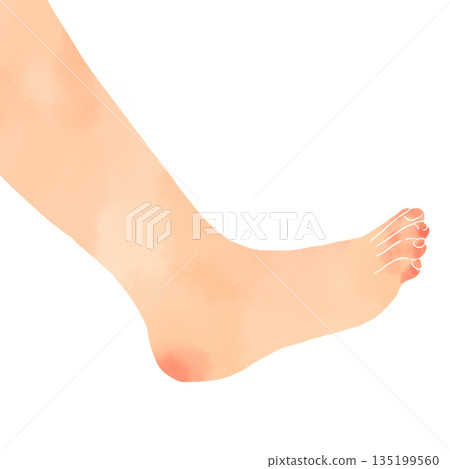 Watercolor illustration of feet, chilblains and cold symptoms image material 135199560