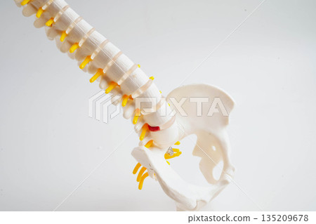 Spinal nerve and bone, Lumbar spine displaced herniated disc fragment, Model for treatment medical in the orthopedic department. 135209678