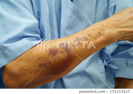 Ecchymosis, elderly bleeding on her arm after taking aspirin. 135213527