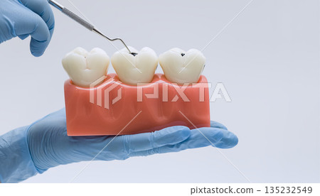 Dental explorer pointing at tooth decay on molar model Dental explorer pointing at tooth decay on molar model 135232549