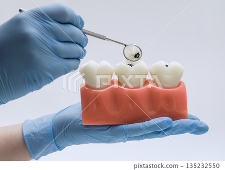 Gloved hands use a dental mirror to inspect visible cavities on a three-molar educational model for oral health training. 135232550