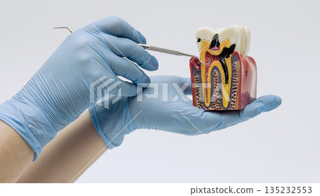 Gloved hands holding a detailed tooth cross section model, illustrating cavity development and internal tooth structure for dental education and healthcare training. Gloved hands holding a detailed tooth cross section model, illustrating cavity development and internal tooth structure for dental education and healthcare training. 135232553