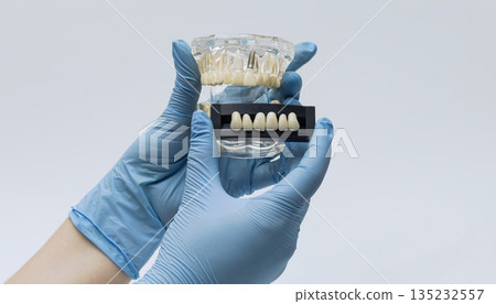 Dental implant model with shade guide comparison Dental implant model with shade guide comparison 135232557