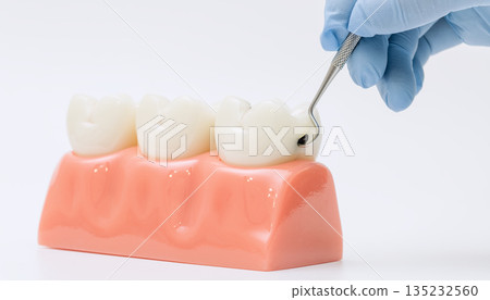 dental explorer examining a decayed molar on a realistic gum model used for educational and clinical training. dental explorer examining a decayed molar on a realistic gum model used for educational and clinical training. 135232560