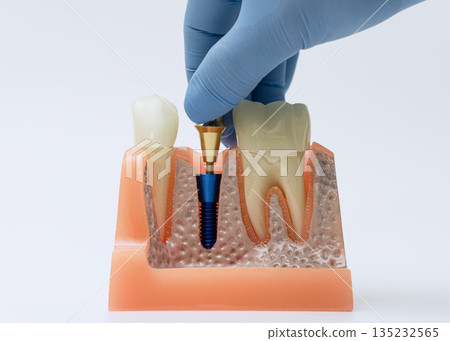Gloved hand demonstrating dental implant placement in model 135232565